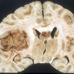 Macroscopic pathology of Glioblastoma multiforme