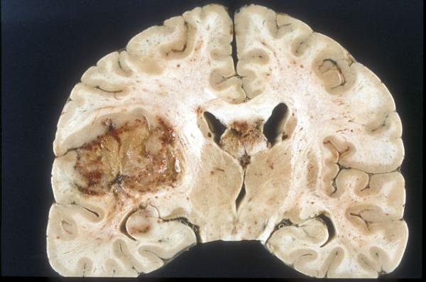 Macroscopic pathology of Glioblastoma multiforme